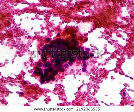 Malignant cells, bronchoalveolar lavage(BAL) adenocarcinoma, show cellular material composed of atypical epithelial cells, acute and chronic inflammatory cells. Cytology test  Royalty-Free Stock Photo #2192065555