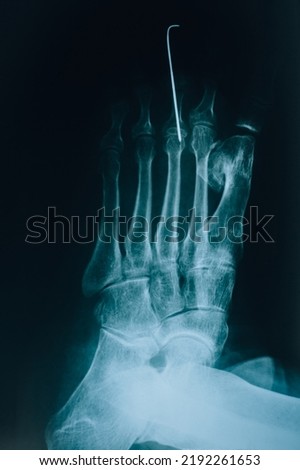 X-ray of the toes. Foot injury. Shot of leg with fixation pins