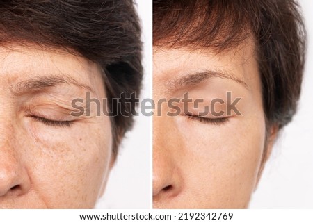 Elderly caucasian woman's face with puffiness under her eyes and wrinkles on eyelids before and after blepharoplasty. Age-related skin changes,fatigue. Result of plastic surgery. Rejuvenation Royalty-Free Stock Photo #2192342769