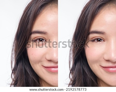 Beautiful woman Asia before and after acne treatment No makeup, close up. Skin care concept White background