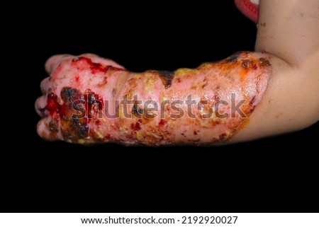 Burn wound surrounded by scabs and exsudates in hand and forearm of Southeast Asian child. Closeup view. Royalty-Free Stock Photo #2192920027