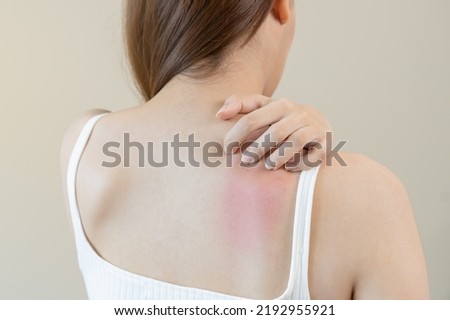Dermatology, asian young woman, girl allergy, allergic reaction from atopic, insect bites on her back, hand in scratching itchy, itch red spot or rash of skin. Healthcare, treatment of beauty. Royalty-Free Stock Photo #2192955921