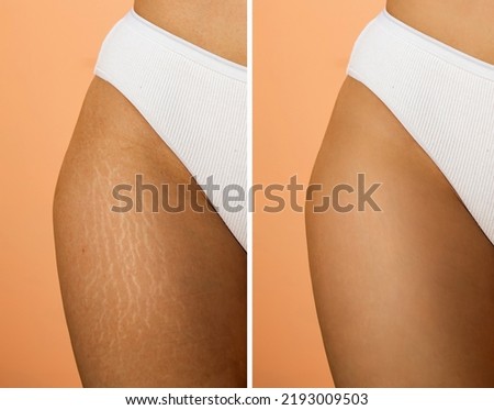 Image compare before and after Woman legs with stretch marks removal treatment, real people. Skin care concept. Royalty-Free Stock Photo #2193009503