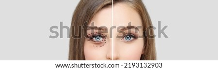 Lower eyelid blepharoplasty.Upper  blepharoplasty.Before and after cosmetic procedures Royalty-Free Stock Photo #2193132903
