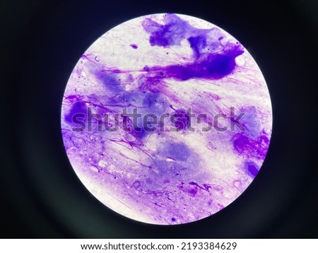 Multinucleated giant cells in Tzanck smear Royalty-Free Stock Photo #2193384629