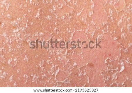 Sunburn, close-up of human skin. Flaky skin from allergies, peeling or eczema. Dry skin in need of treatment and hydration. Royalty-Free Stock Photo #2193525327