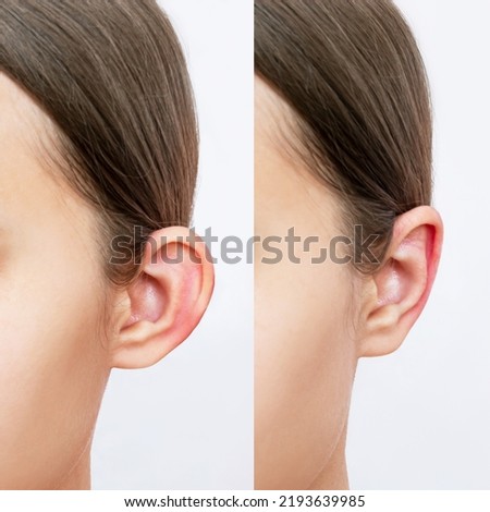 Cropped shot of young woman's head with ears before and after otoplasty on a white background. Result of cosmetic plastic surgery of correction auricles and getting rid of lop - eared Royalty-Free Stock Photo #2193639985