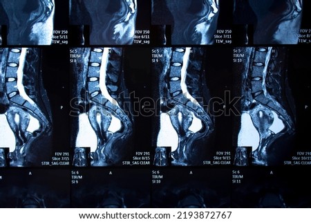 
MRI image of the lumbosacral region of a human woman with coccyx subluxation. X-ray picture.