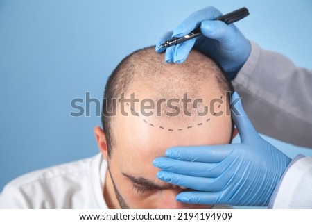Patient suffering from hair loss in consultation with a doctor.  Royalty-Free Stock Photo #2194194909