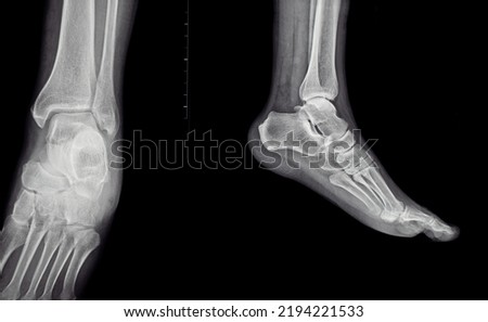 A close-up x-ray of the sole of the human foot