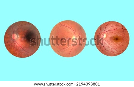 View inside human eye disorders - showing retina, optic nerve and macula.Retinal picture ,Medical photo tractional (eye screen) retinal detachment of diabetes.Eye treatment concept.