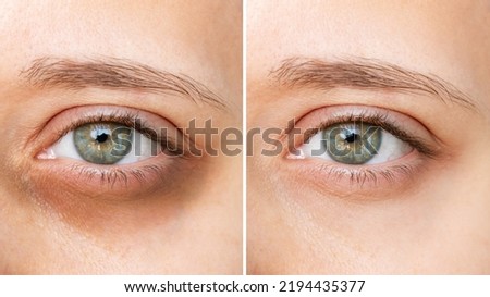 Cropped shot of young caucasian woman's face with dark circles under eyes before and after cosmetic treatment on a white bqckground. Bruises under eyes. Result of using concealer Royalty-Free Stock Photo #2194435377