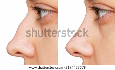 Profile of woman's face with nose before and after rhinoplasty isolated on white background. The result of cosmetic plastic surgery on the nose. Correction of the nasal septum. Getting rid of the hump Royalty-Free Stock Photo #2194435379