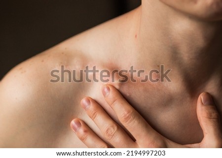 Close-up of man's collarbone injury. Black background. Injured athlete after successful fractured clavicle bone surgery and osteosynthesis of broken collarbone with titanium plate or metal clamp. Royalty-Free Stock Photo #2194997203