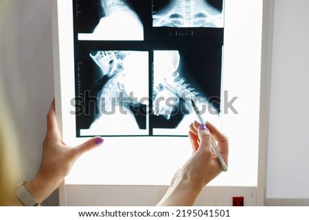 Close up view of doctor hand with pen pointing at x-ray image of neck