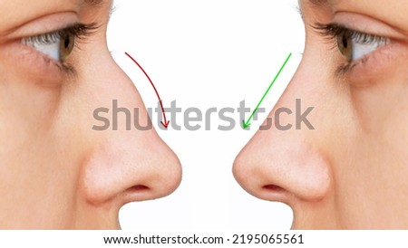 A profile of woman's face with nose before and after rhinoplasty isolated on white background. Comparison after cosmetic plastic surgery on the hump of the female nose. Correction of the nasal septum Royalty-Free Stock Photo #2195065561