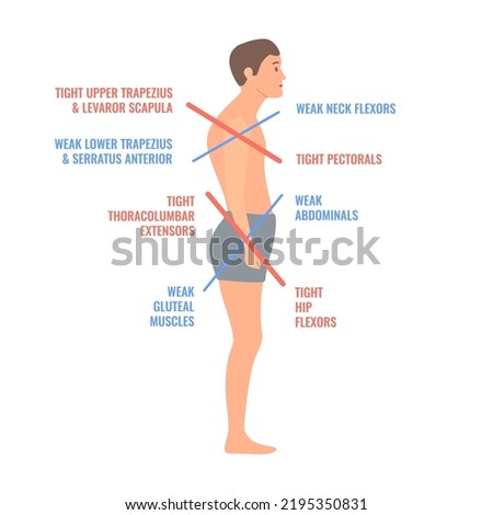 Upper and lower crossed syndrome medical diagram. Crooked man with muscle strength imbalance. Weak and overactive muscles therapy. Incorrect spine curvature caused by bad posture. Vector
