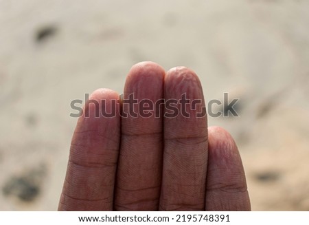Pruney fingers, a medical condition with wrinkled finger skin.