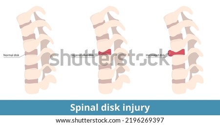 Spinal disk injury.	The herniated disk causes pain, numbness, or weakness, and the degenerative disk results as dry out or cracking.  Causes of spinal pain and damage. Royalty-Free Stock Photo #2196269397