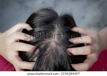 young woman with thin hair problem, top view of scalp spot baldness make people lack of confidence, a girl worry about hair fall problem Royalty-Free Stock Photo #2196284497