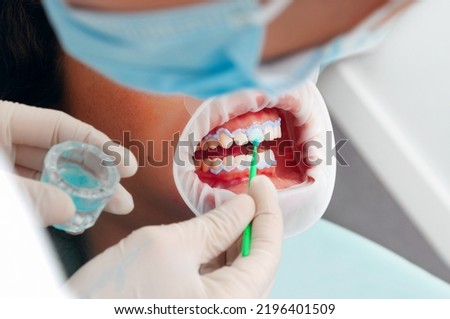 Dentist and patient applying product on a patient. Tooth whitening on the dental room Royalty-Free Stock Photo #2196401509