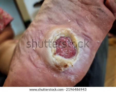 A diabetic foot ulcer presents significant morbidity to patients. Royalty-Free Stock Photo #2196486943