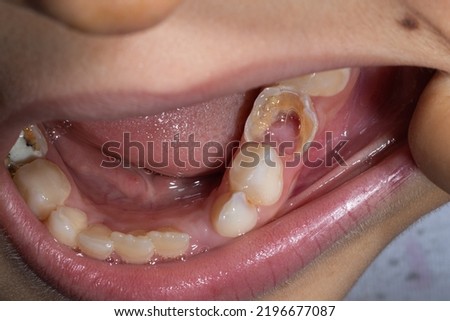 milk teeth caries, carious child teeth	 Royalty-Free Stock Photo #2196677087