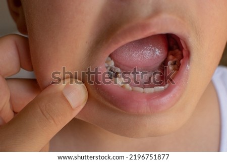 caries teeth of a child. visual for dentist. Royalty-Free Stock Photo #2196751877