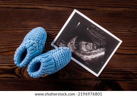Newborn booties and prenatal ultrasound screening of unborn baby