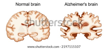 Normal brain and Alzheimer's brain. neurodegenerative disease. Vector illustration Royalty-Free Stock Photo #2197115107