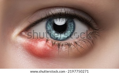 Eye of a girl with stye close-up. Acute purulent inflammation of the hair follicle of the eyelashes of a young woman. Treatment and prevention of eye diseases. Royalty-Free Stock Photo #2197750271
