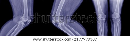 Young man's knee x-ray during normal age with knee pain