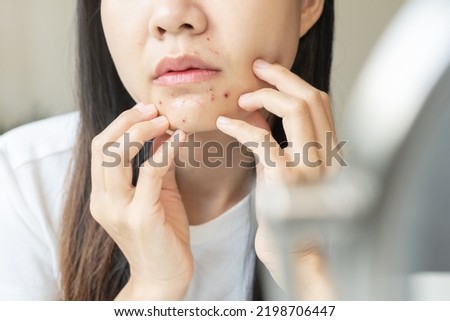 Expression worry asian young woman hand touching pustule around the chin and mouth, allergic when wear mask, makeup, show squeezing pimple spot from face. Beauty care, skin problem by acne treatment. Royalty-Free Stock Photo #2198706447