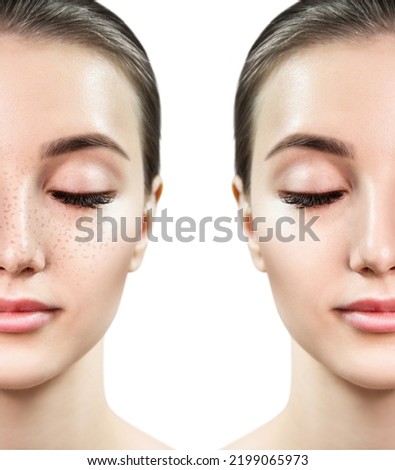 Young woman before and after freckles removal on face. Isolated on white background.