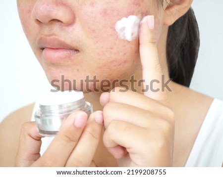 Young woman holding cream jar  and applying acne cream on her face for treat her skin. Concept of beauty and cosmetic. Closeup photo, blurred.