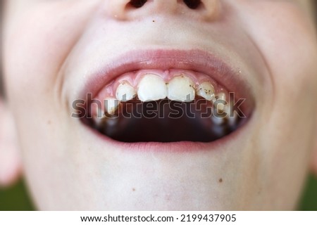 open mouth of a child boy with plaque or calculus on the teeth close. oral hygiene concept. Royalty-Free Stock Photo #2199437905