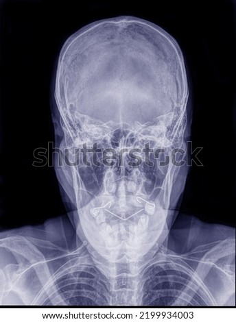 X-ray photograph The head of a middle-aged man had an accident, slipped and hit the ground.