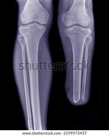 X-ray picture of the leg being operated from a motorcycle accident
