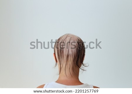 Hair loss in the form of alopecia areata. Bald head of a woman. Hair thinning after covid. Bald patches of total alopecia Royalty-Free Stock Photo #2201257769