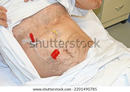 Feeding tube inserted into a mans stomach Royalty-Free Stock Photo #2201490785