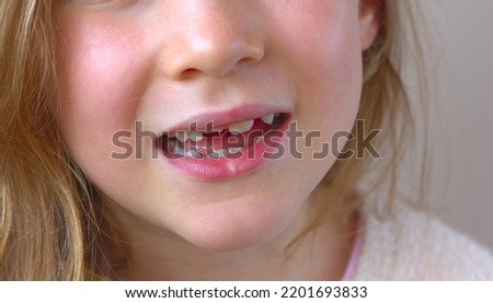 A close-up of the smile of a little girl without milk teeth, with growing permanent teeth.