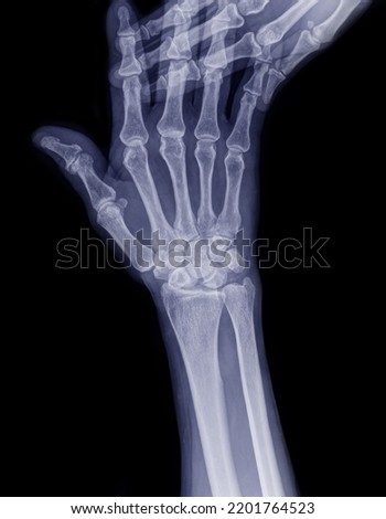 
wrist bone x-ray picture, severe wrist pain