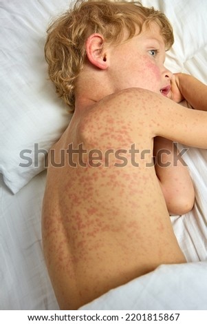 Sick little boy lies on his side on a hospital bed with a red rash all over his body. Child with a severe allergic reaction in the form of a rash in a hospital under the supervision of doctors Royalty-Free Stock Photo #2201815867