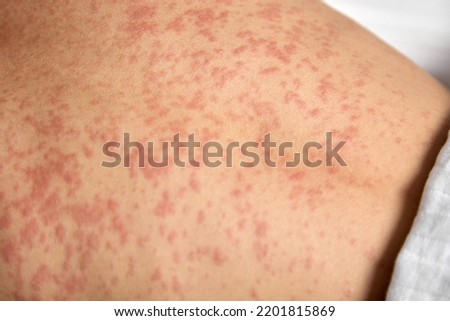 Close-up of a red rash on the human body. Human skin is covered with painful red spots Royalty-Free Stock Photo #2201815869