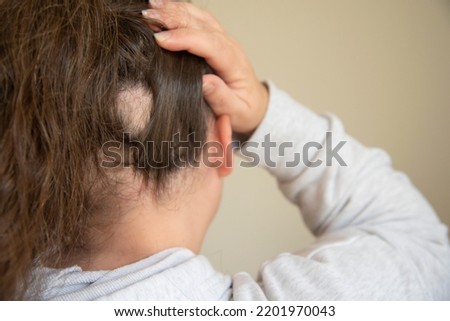 white woman with alopecia hair loss Royalty-Free Stock Photo #2201970043