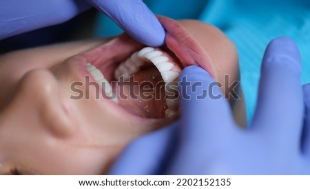 Doctor dentist examining patient oral cavity with veneers closeup Royalty-Free Stock Photo #2202152135