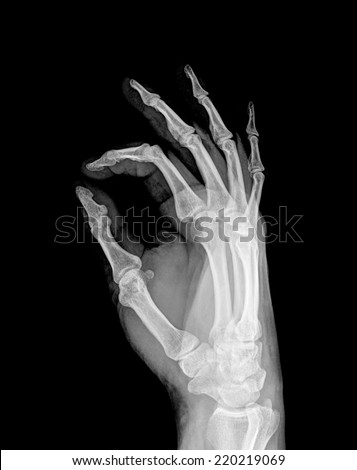 X-ray of both human hand (OK!)