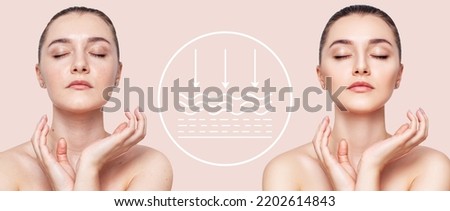 Woman before and after lifting skin. Infographic shows deep penetration of remedy in skin. Royalty-Free Stock Photo #2202614843