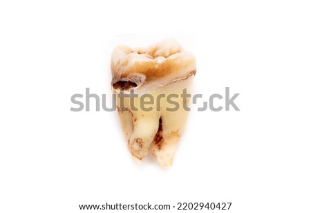 Close-up of a tooth with caries isolated on a white background. Removed wisdom teeth. Sick human teeth. Royalty-Free Stock Photo #2202940427
