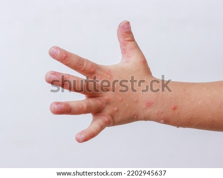 Hand-foot-and-mouth disease HFMD human hand of scarlet fever on palm enterovirus Coxsackie virus isolated on white background. Royalty-Free Stock Photo #2202945637